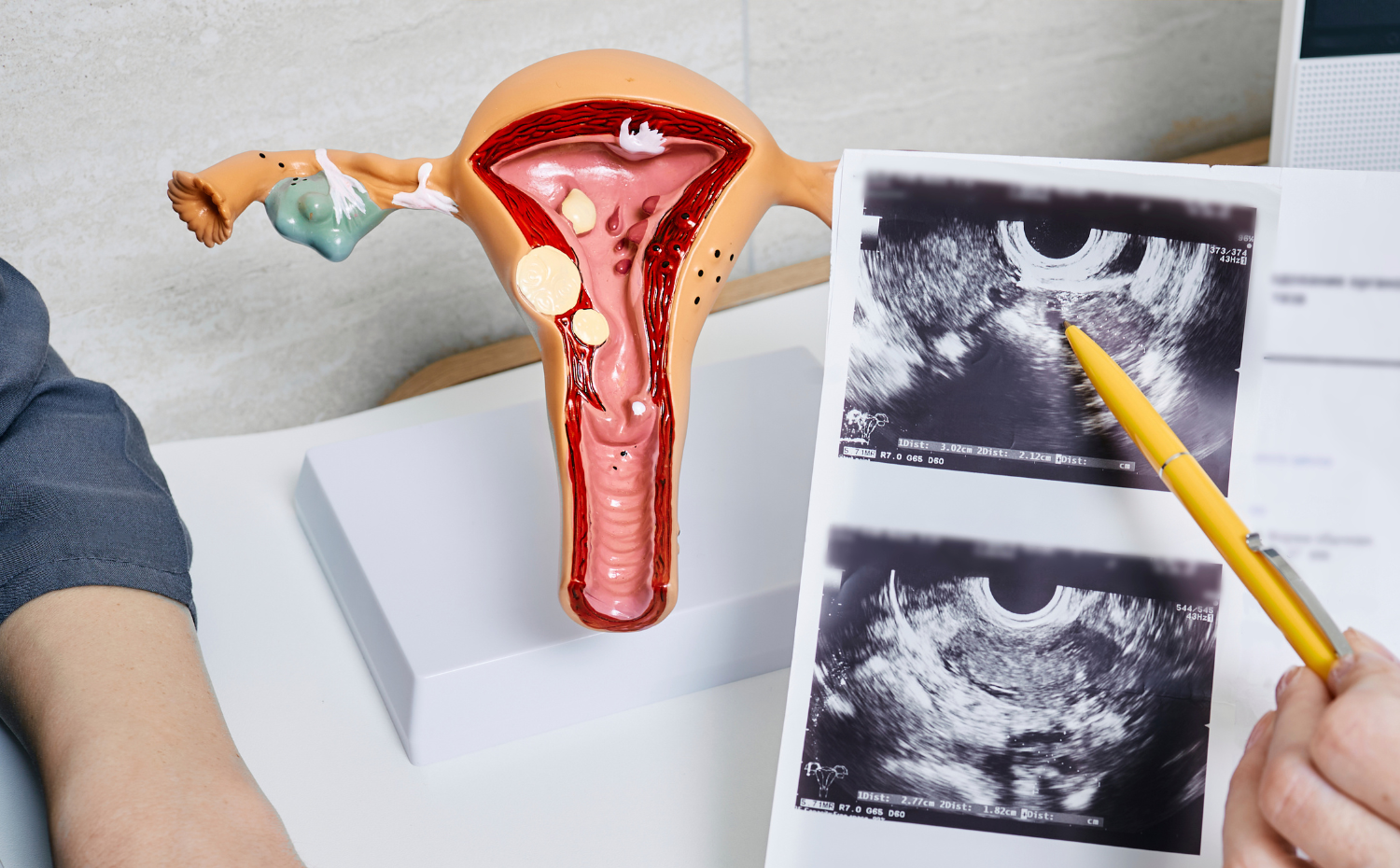 Female Fertility Causes and Support in Malaysia | Xi Fertility
